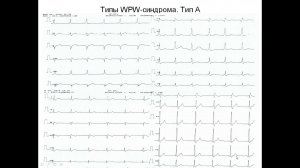 WPW на ЭКГ