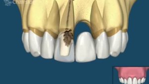 Что лучше керамическая коронка или имплантации востоновление зубов