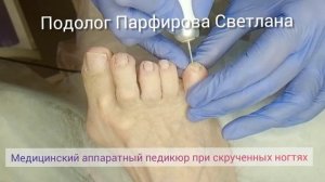 Аппаратный педикюр. Возрастные скрученные ногти.