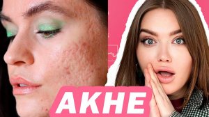АКНЕ изучение проблемы! (Лекция 1-2 из марафона по лечению АКНЕ)