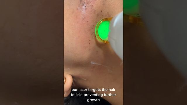 REMOVING BLACKHEADS, BLACKHEADS 2021 NEW, REMOVE & EXTRACT CYSTIC ACNE, MILIA REMOVAL,