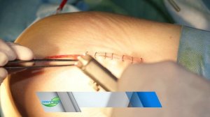 Сшиватель кожи хирургический многоразовый СКМ - 1
