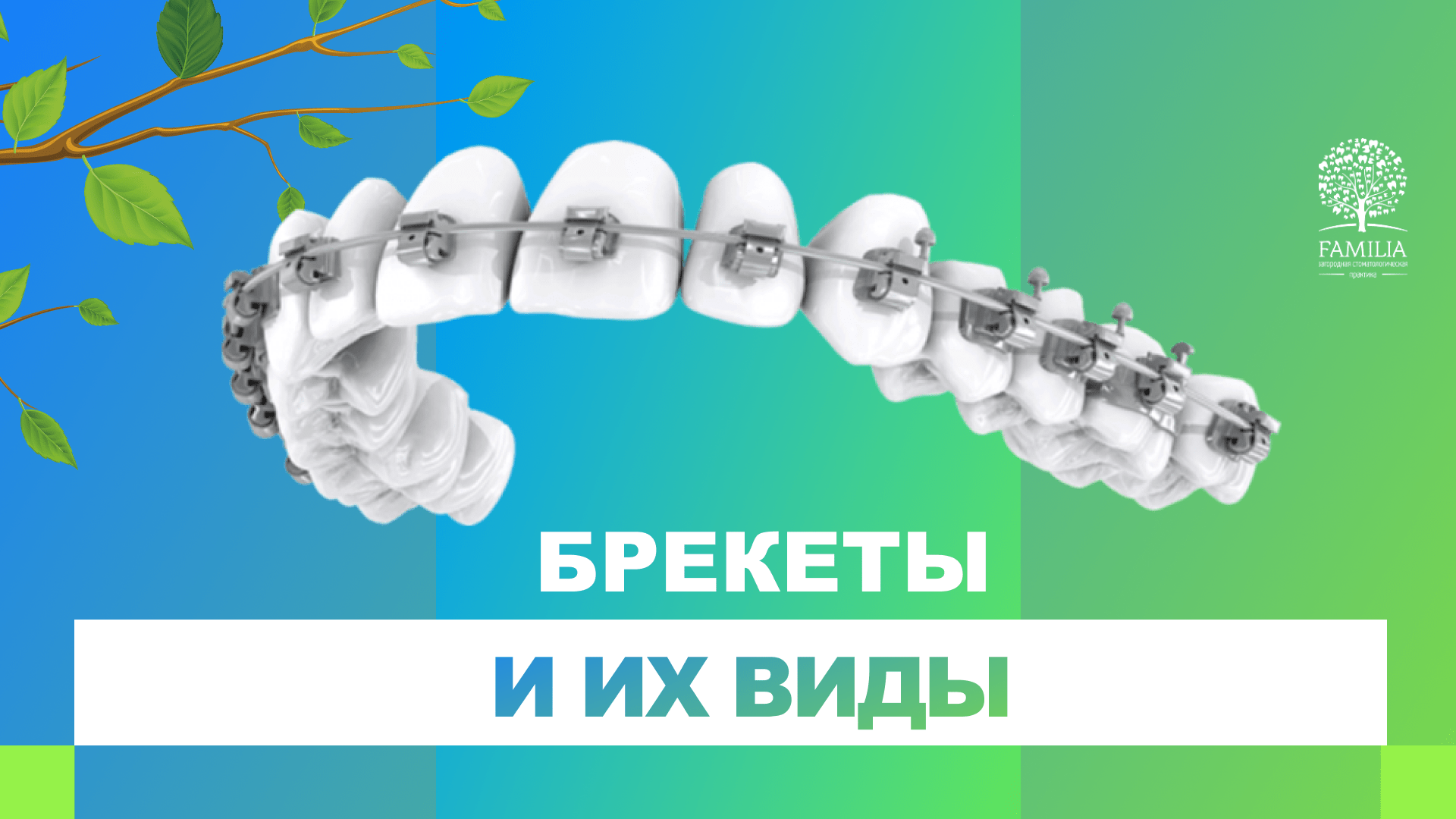 ? Брекеты и их виды