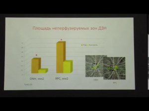 Морфометрия и микроциркуляция диска зрительного нерва у больных нормотензивнойглаукомой