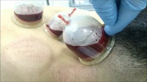 Хиджама головы. Улучшение кровообращения حجامة رأس و عنق