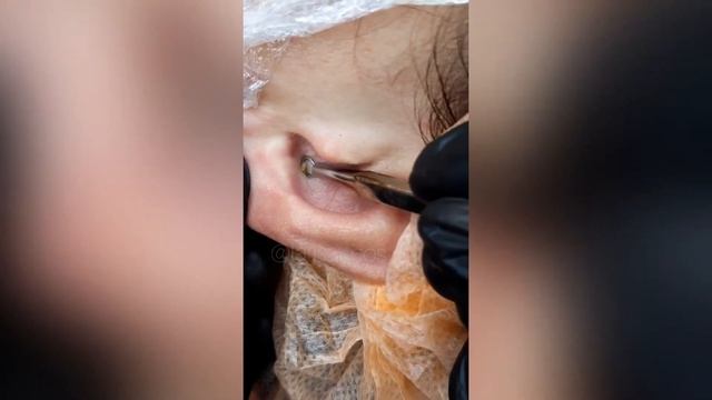 давить прыщи 2 //Blackhead whiteheads Removal//залипательные//RELAX video//черные точки 2021.10.18