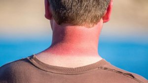 Güneş Yanığı Nasıl Geçer / Güneş Yanığı Tedavisi