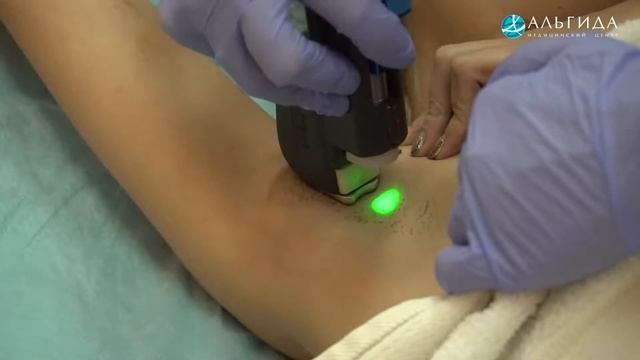 Лазерная эпиляция (Медцентр "Альгида") смотреть онлайн
