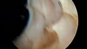 Биполярная трансуретральная резекция (ТУР) предстательной железы/Transurethral Resection of Prostat