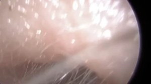 1,068 - Fungal-Coated Ear Wax Removal