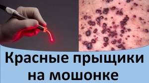 Красные прыщики на мошонке.