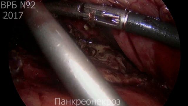 Панкреонекроз