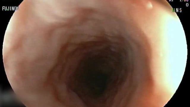Endoscopia con biopsia смотреть онлайн