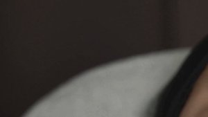 Реденсифікація. Омолодження периорбітальної зони препаратом Teosyal® Redensity1. Людмила Безпалько