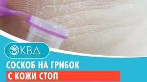 ✅ Соскоб на грибок с кожи стоп. Клинический случай №651