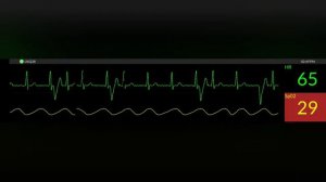 смерть мозга.но сердце бьеться