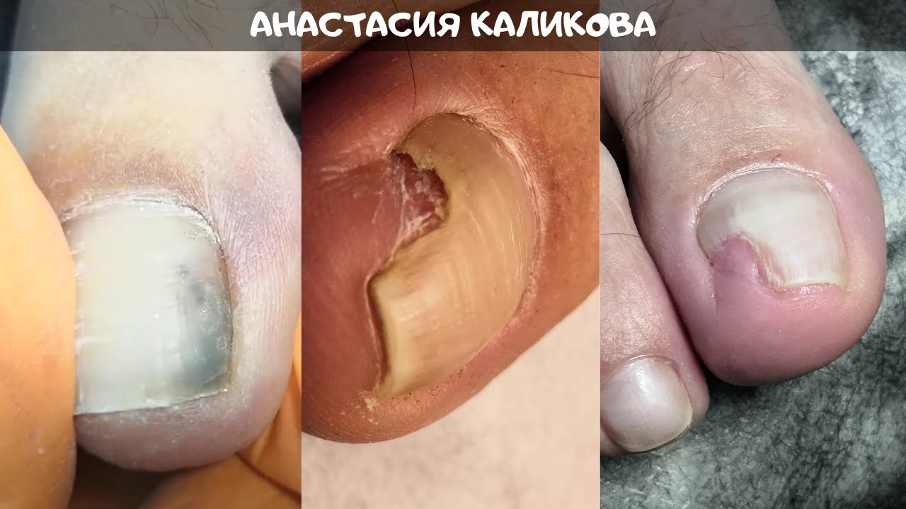 ПЕДИКЮР и Онихолизис/Отслоения и Пустота под ногтем/Обработка пальцев ног с ОНИХОЛИЗИСОМ