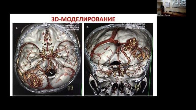 Цикл лекций: "Нейрохирургические подходы к лечению цереброваскулярной патологии". смотреть онлайн
