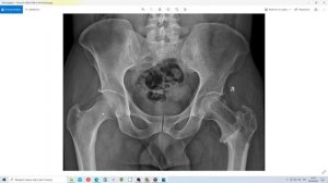 Перелом бедра. Рентгеновские снимки после снятия остеосинтеза.