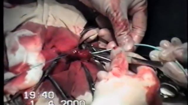 Пластика маточных труб после стерилизации смотреть онлайн