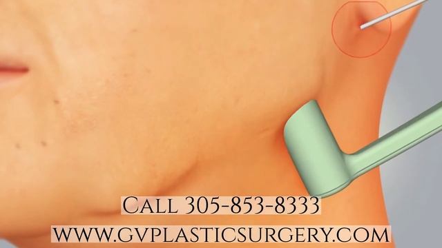New Skin Tightening Treatment in Miami - Morpheus 8 by Dr. Varkarakis смотреть онлайн