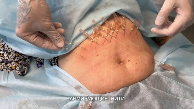 МЕЗОНИТИ куда можно ставить? КУДА? ЗАЧЕМ? ПОЧЕМУ? Вечная молодость #мезонити