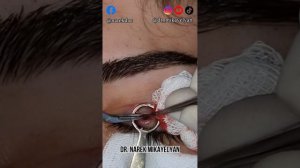 🇺🇲 Chalasion Surgery, 🇦🇲 Խալազիոնի հեռացում🇷🇺 Удаление халязиона