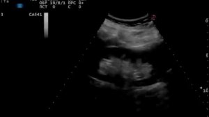 Кисты правой почки