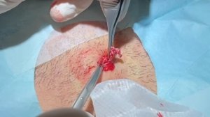 Pressurized Jawline Abscess Cyst. Squirting cyst pop with surprising large sac dissection on neck.