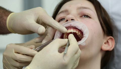 Перезагрузка: Кариес и реставрация зубов