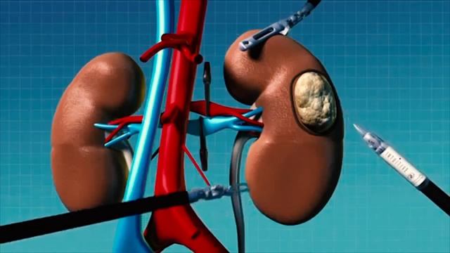 Резекция почки: удаление рака с сохранением органа смотреть онлайн