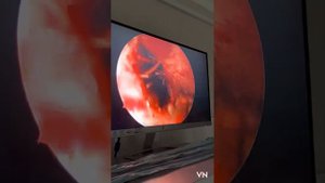 Инородное тело Гайморотомия