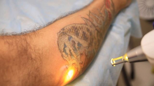 4 сеанс удаления татуировки неодимовым Q-Switched Nd:YAG лазером. смотреть онлайн