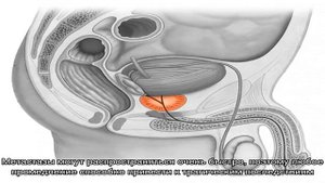 Почему может болеть простата и что с этим делать?