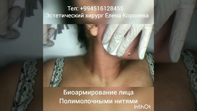 Биоармирование лица полимолочными нитями смотреть онлайн