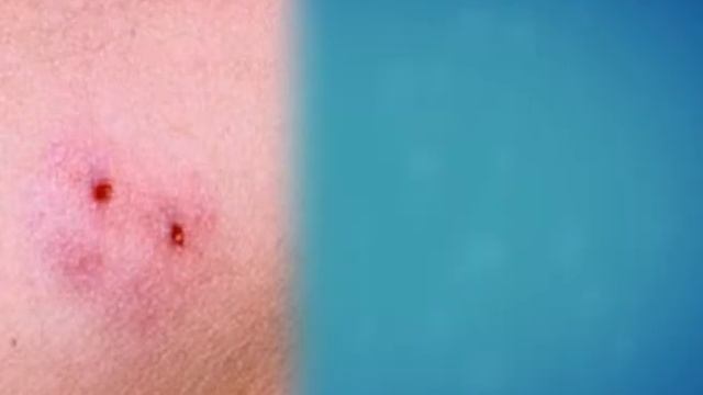 Что делать, если укусила змея смотреть онлайн