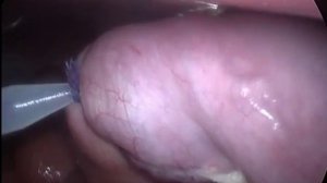 Лапароскопическая резекция дивертикула Меккеля у детей