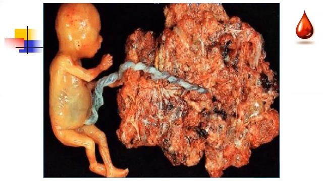 Акушерские кровотечения во время беременности, в последовом и послеродовом периодах