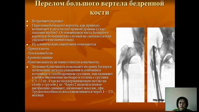 Улукбекова А.О. - лекция " ЛФК при внутрисуставных и диафизарных переломах бедра"