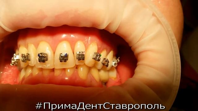 Установка брекетов в Ставрополе смотреть онлайн