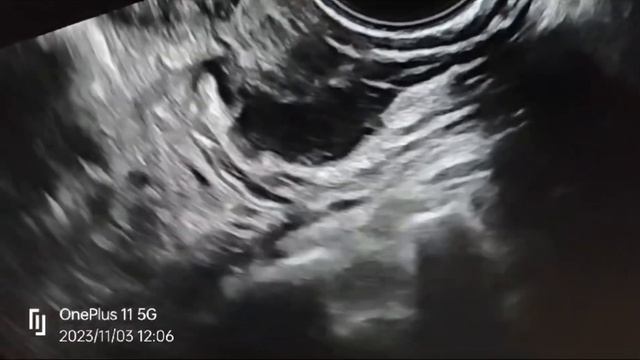 УЗИ диагностика эндометриоза от dr. Jay Metha с моим синхронным переводом. смотреть онлайн