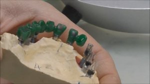 Каркасы на Имплантаты AstraTech винтовая фиксация под пластмассу.