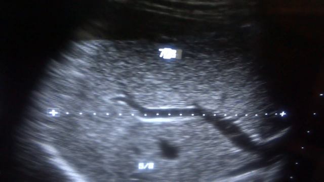 ULTRASOUND LIVER LOBES and SEGMENTS part 2 of 4 смотреть онлайн