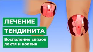 Лечение тендинита. Воспаление связок локтя и колена.
