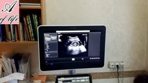 УЗИ 17 недель беременности. Скрининг 17 недель, пол ребенка