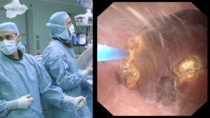 Flexible Ureteroscopy and Laser Dusting of 8 mm Kidney Stone