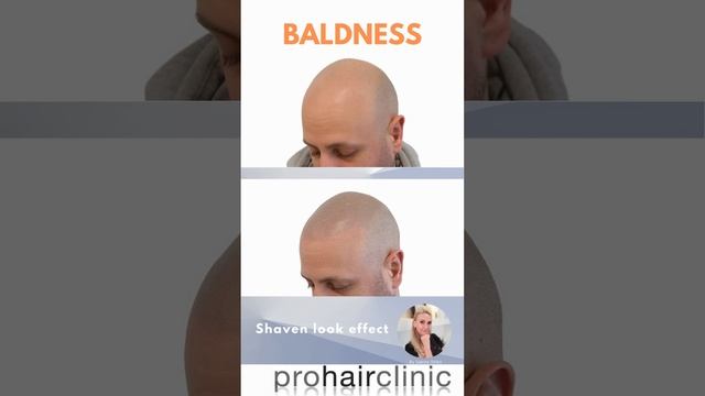 Exceptional treatment solves even advanced hair loss WITHOUT surgery – SMP!