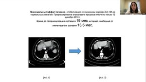 Особенности лекарственной терапии рака яичника препаратом липосомальный доксорубицин в клин практике