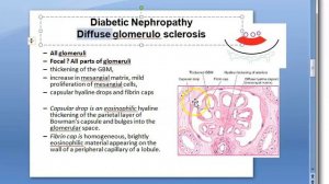 Pathology 681 a Diabetic Nephropathy Renal armanni ebstein kimmelstiel wilson KW lesion capsular