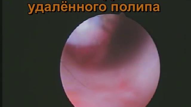 Аденоматозные полипы эндометрия. Постменопауза.